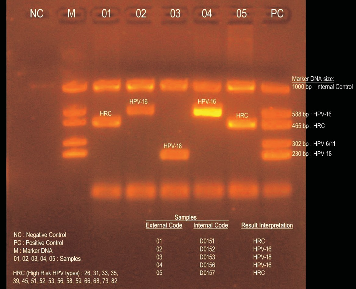 Phương pháp PCR – Điện di trong phát hiện HPV nguy cơ cao (Nguồn: Internet)